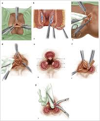 Cắt trĩ theo Milligan Morgan
